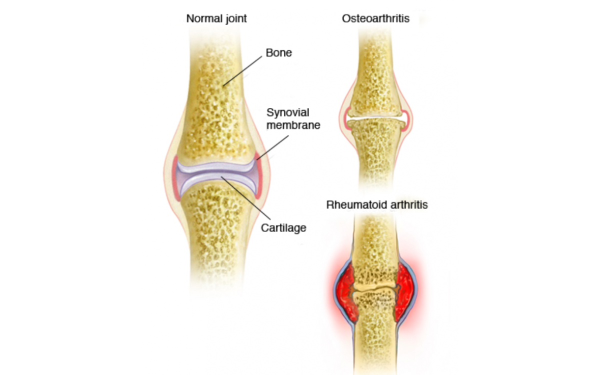 Arthritis nghĩa là gì ? Những hiểu biết cơ bản về bệnh viêm khớp (Arthritis).